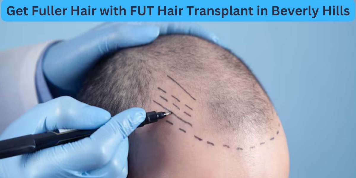 Get Fuller Hair with FUT Hair Transplant in Beverly Hills