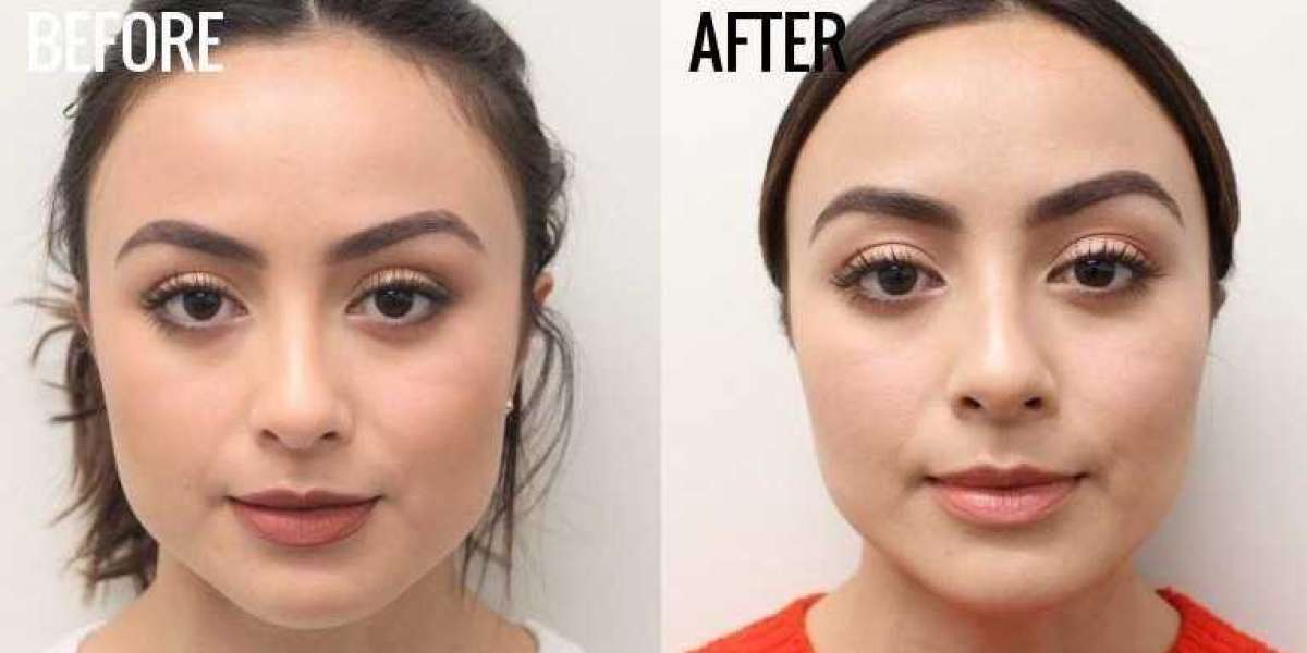 See Jawline Botox Before and After for Real Transformations