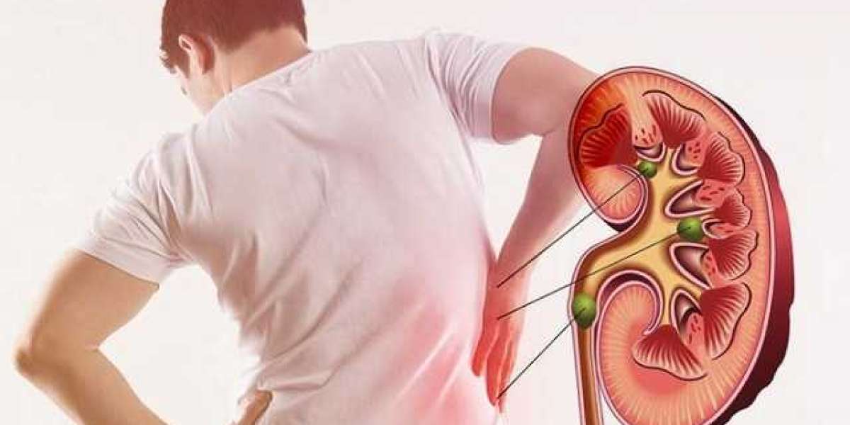 Is Your Back Pain Warning You About Kidney Stones?