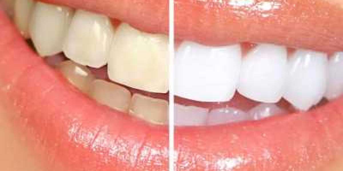 Teeth Whitening in Islamabad: Quick Fix for Yellow Teeth