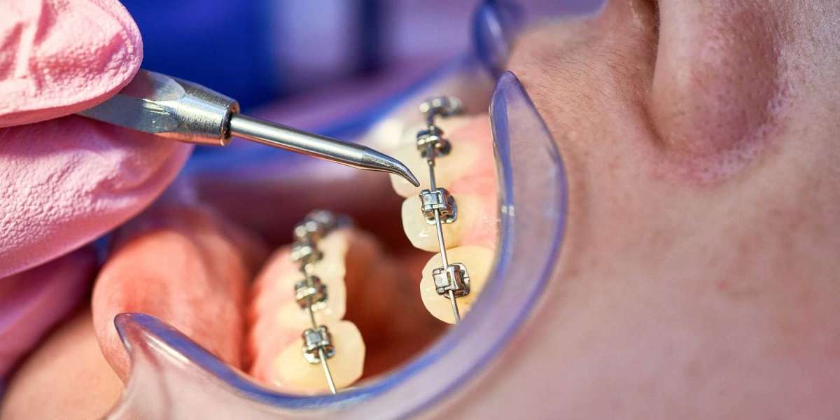 Ortodoncia Invisible en Barcelona con Tecnología Invisalign- Avanzada