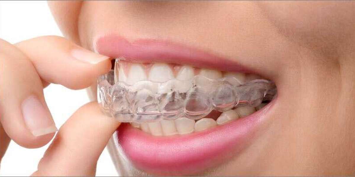 Mouth Guards: How They Prevent Dental Emergencies
