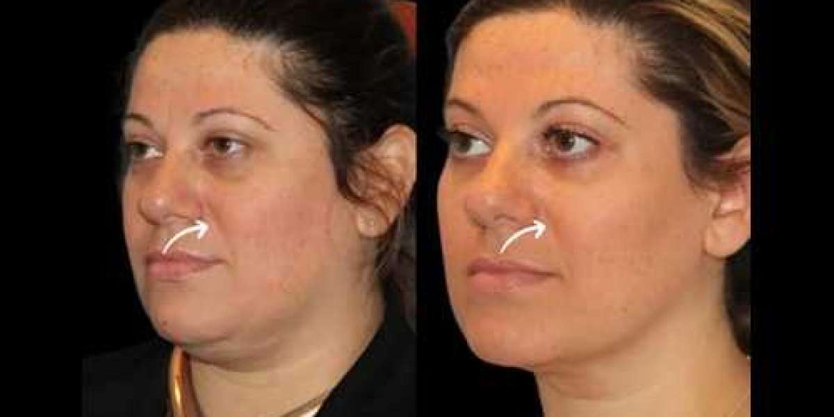 Best Aesthetic Clinics in Dubai The Rise of Sculptra Beauty